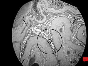 M,69y. | advanced diabetic glomerulosclerosis- thickened basement membranes,fused pedicles M,69y. | advanced diabetic glomerulosclerosis- thickened basement membranes,fused pedicles